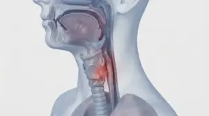 Illustrazione medica della gola con evidenza di un'infiammazione nella zona laringea